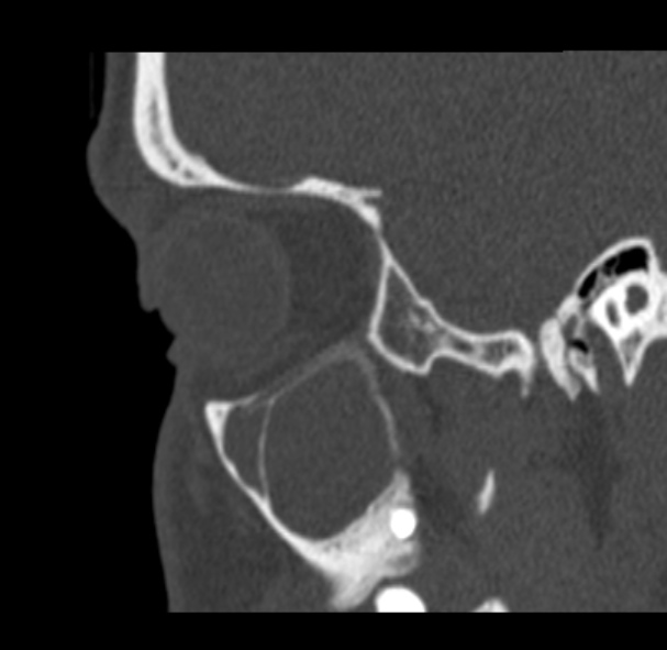 File:Antrochoanal polyp (Radiopaedia 33984-35202 Sagittal bone window 15).jpg