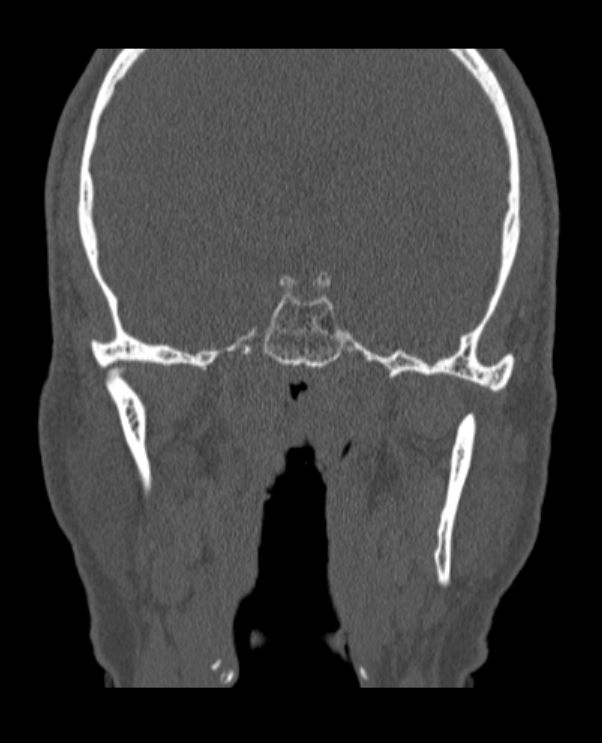 Antrochoanal polyp (Radiopaedia 79011-92169 Coronal bone window 4).jpg