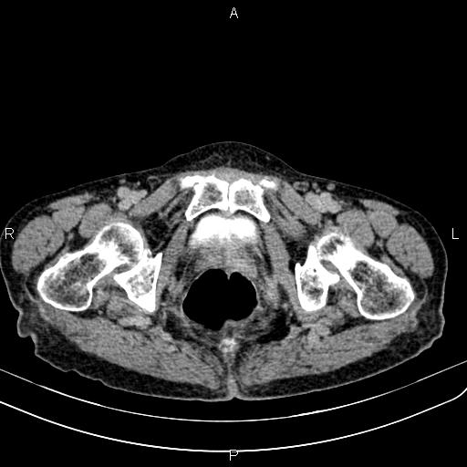 Aortic aneurysm and Lemmel syndrome (Radiopaedia 86499-102554 Axial C+ delayed 79).jpg