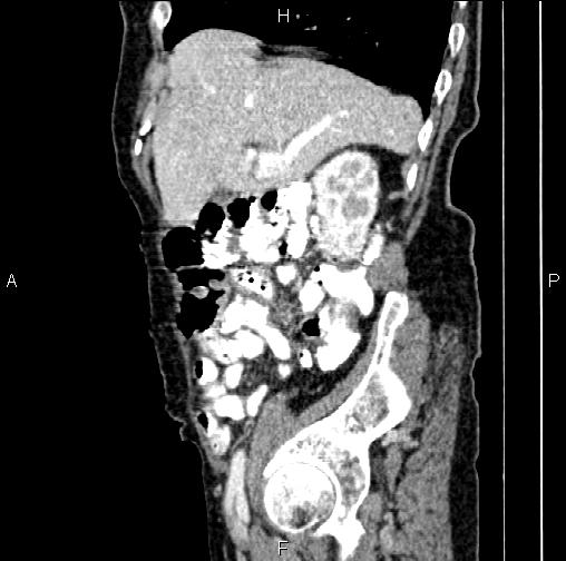 Aortic aneurysm and Lemmel syndrome (Radiopaedia 86499-102554 D 21).jpg