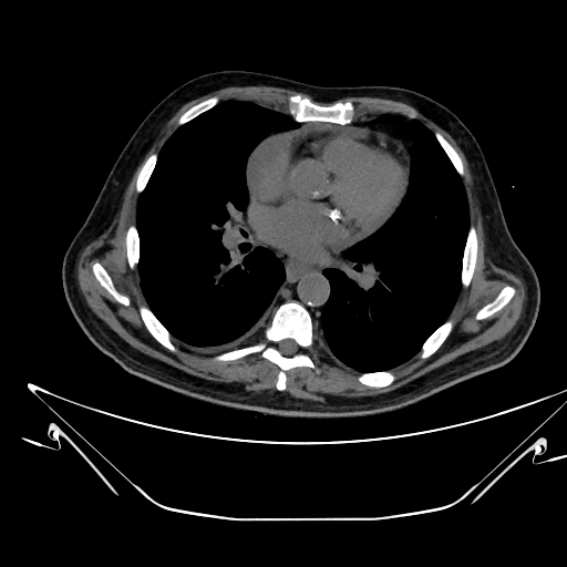 Aortic arch aneurysm (Radiopaedia 84109-99365 Axial non-contrast 154).jpg