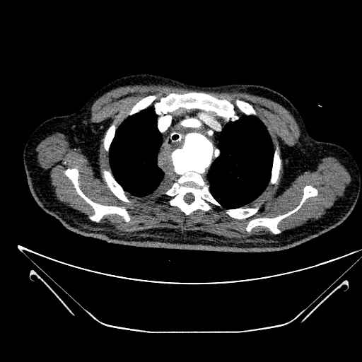 Aortic arch aneurysm (Radiopaedia 84109-99365 B 140).jpg