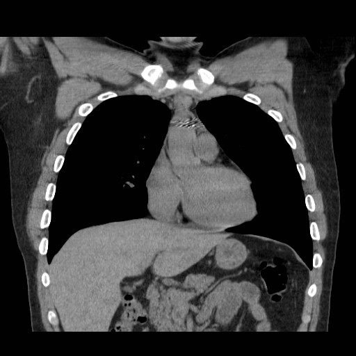 File:Aortic arch stent (Radiopaedia 30030-30595 Coronal non-contrast 2).jpg