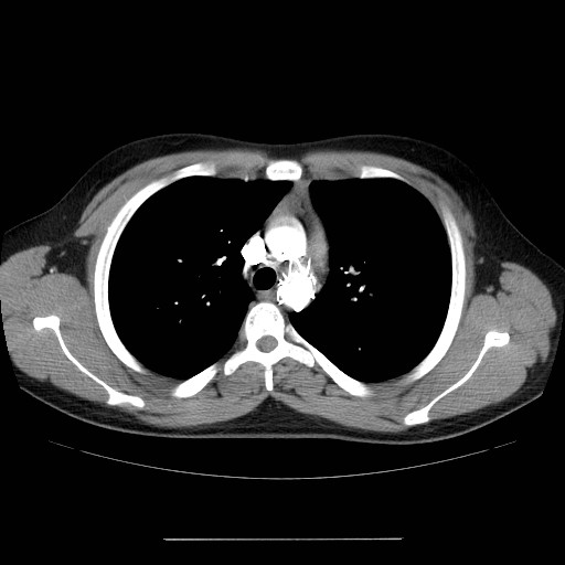 File:Aortic arch stent (Radiopaedia 30030-30595 D 11).jpg