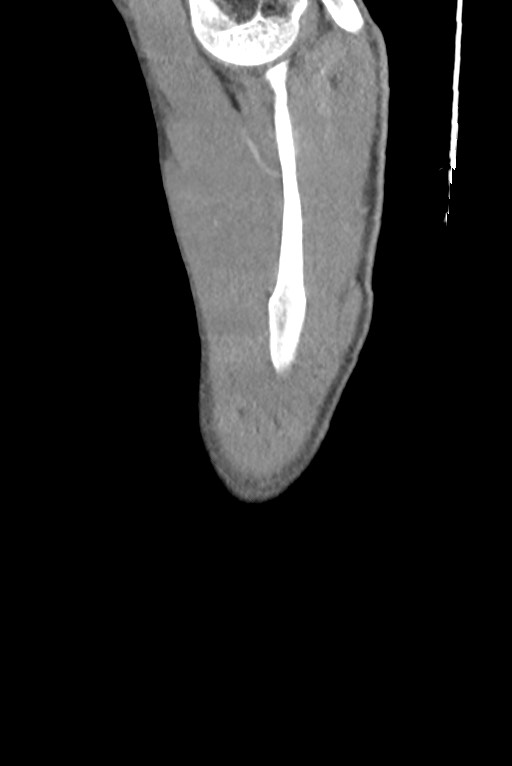 Aortic coarctation with aneurysm (Radiopaedia 74818-85828 B 5).jpg