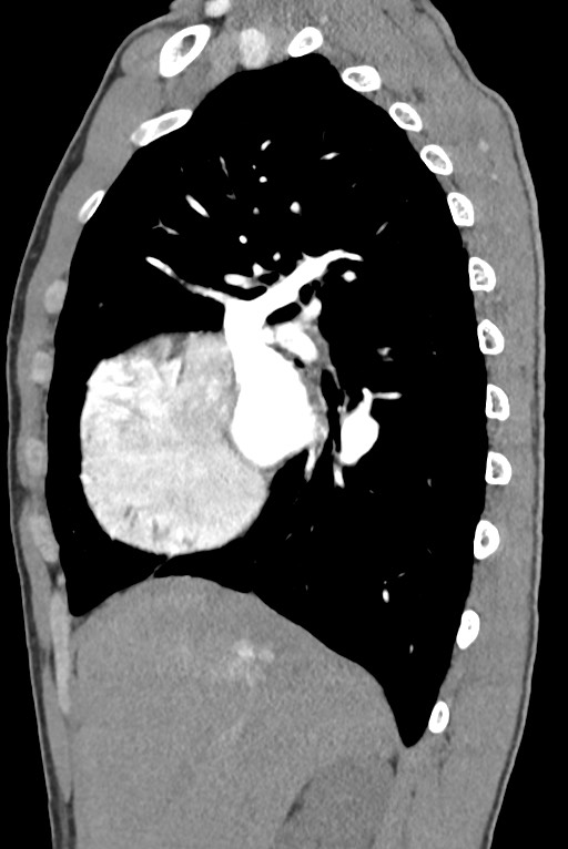 Aortic coarctation with aneurysm (Radiopaedia 74818-85828 B 56).jpg