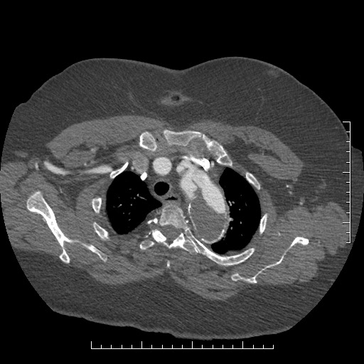 Aortic dissection- Stanford A (Radiopaedia 35729-37268 A 9).jpg