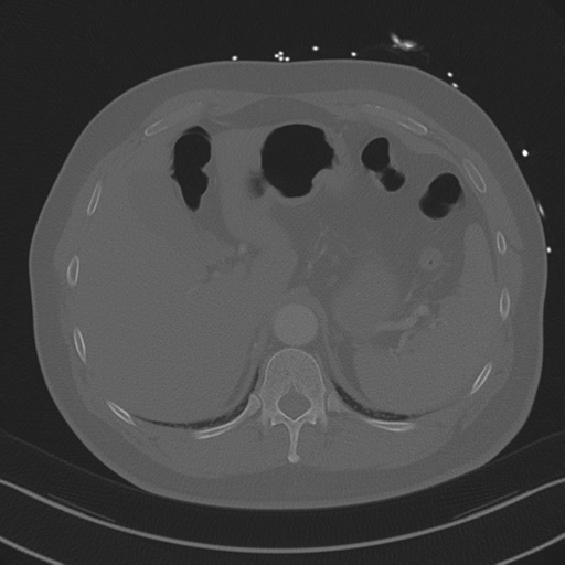 Aortic dissection (Radiopaedia 50763-56234 Axial bone window 96).png