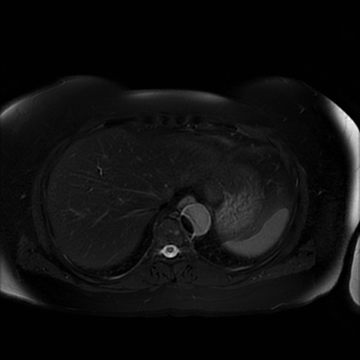 File:Aortic dissection (Radiopaedia 57969-64956 Axial T2 fat sat 13).jpg