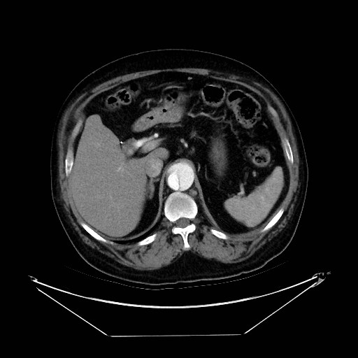 Aortic dissection (Radiopaedia 62562-71000 A 50).jpg