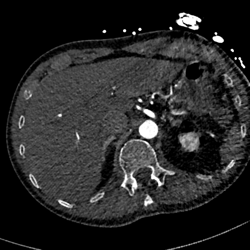 File:Aortic dissection - DeBakey type II (Radiopaedia 64302-73082 A 89).png