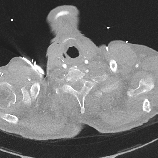 File:Aortic dissection - DeBakey type II (Radiopaedia 64302-73082 Axial lung window 2).png