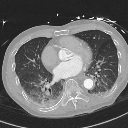 File:Aortic dissection - DeBakey type II (Radiopaedia 64302-73082 Axial lung window 39).png