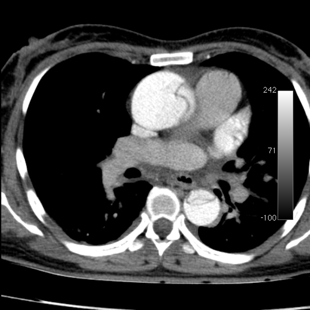 Aortic dissection - Stanford type A (Radiopaedia 29247-29659 A 39).jpg