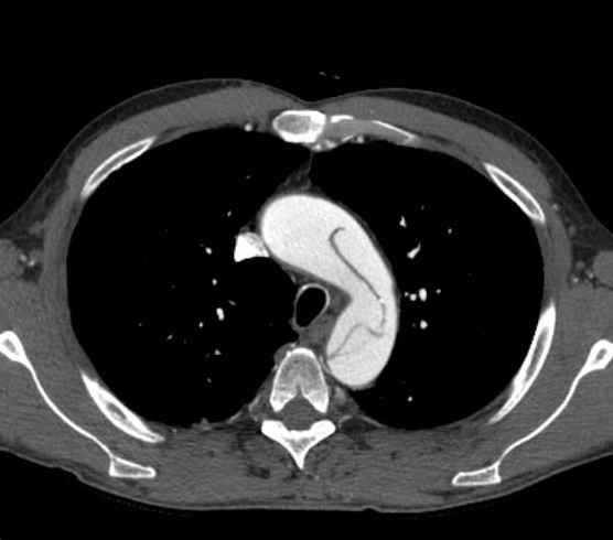 Aortic dissection - Stanford type B (Radiopaedia 73648-84437 A 24).jpg