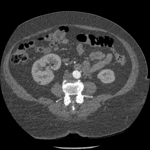 File:Aortic dissection - Stanford type B (Radiopaedia 88281-104910 A 127).jpg