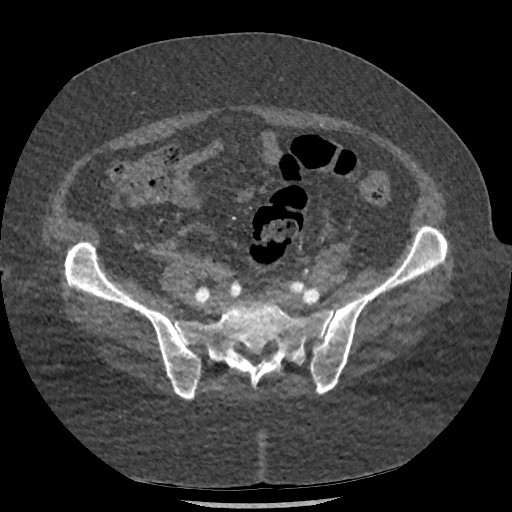 File:Aortic dissection - Stanford type B (Radiopaedia 88281-104910 A 140).jpg