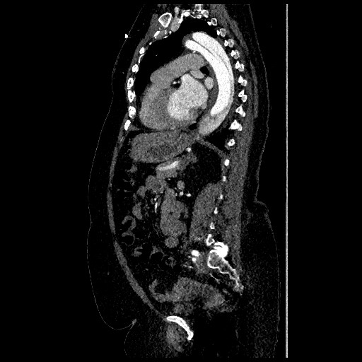 Aortic dissection - Stanford type B (Radiopaedia 88281-104910 C 51).jpg