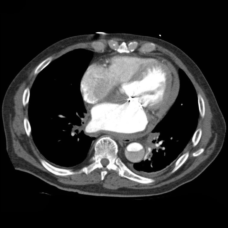 Aortic dissection with rupture into pericardium (Radiopaedia 12384-12647 A 36).jpg