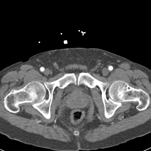 Aortic intramural hematoma (Radiopaedia 31139-31838 B 168).jpg