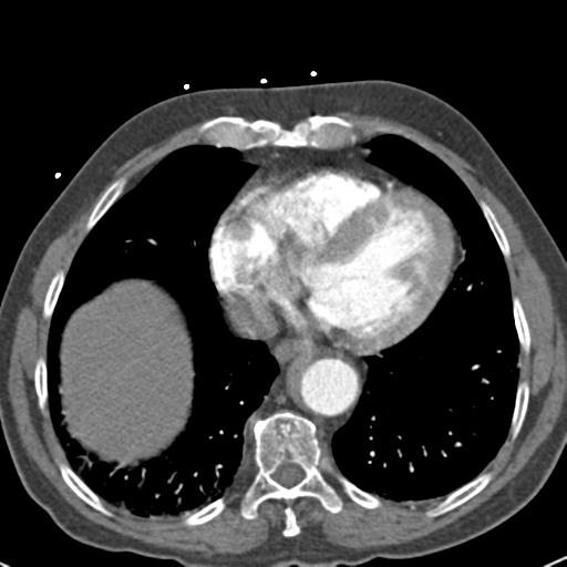 File:Aortic intramural hematoma (Radiopaedia 31139-31838 B 62).jpg
