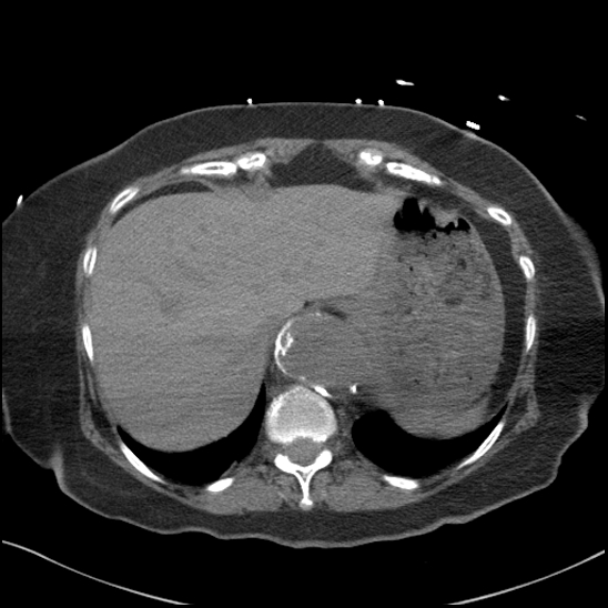 Aortic intramural hematoma with dissection and intramural blood pool (Radiopaedia 77373-89491 Axial non-contrast 86).jpg