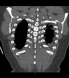 Aortic valve endocarditis (Radiopaedia 87209-103485 D 10).jpg