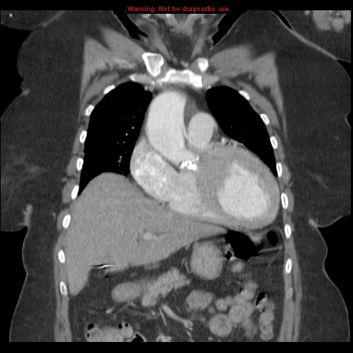 File:Aortic valve stenosis (Radiopaedia 14480-14423 A 3).jpg