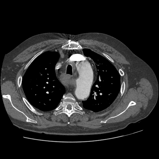 File:Aorto-coronary bypass graft aneurysms (Radiopaedia 40562-43157 A 32).png