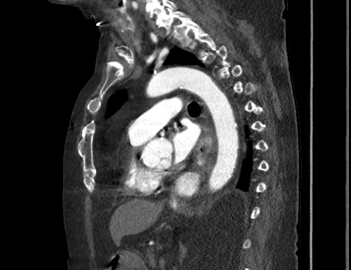 Aortoesophageal fistula with endovascular repair (Radiopaedia 73781-84592 Sagittal C+ CTPA 114).jpg