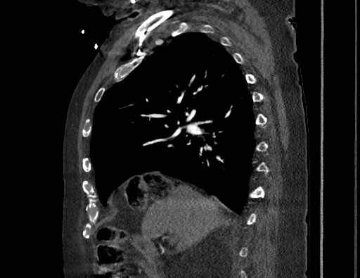 Aortoesophageal fistula with endovascular repair (Radiopaedia 73781-84592 Sagittal C+ CTPA 68).jpg