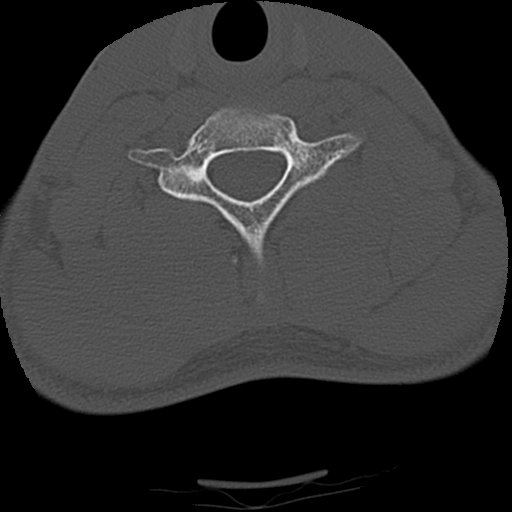 Apical pneumothorax on cervical spine CT (Radiopaedia 45343-49368 Axial bone window 67).jpg