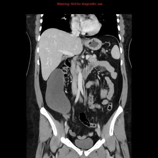 Appendiceal mucinous cystadenoma (Radiopaedia 8263-9111 B 35).jpg