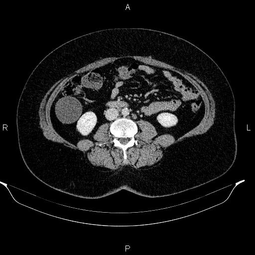 Appendiceal mucocele (Radiopaedia 83280-97688 Axial With contrast 58).jpg