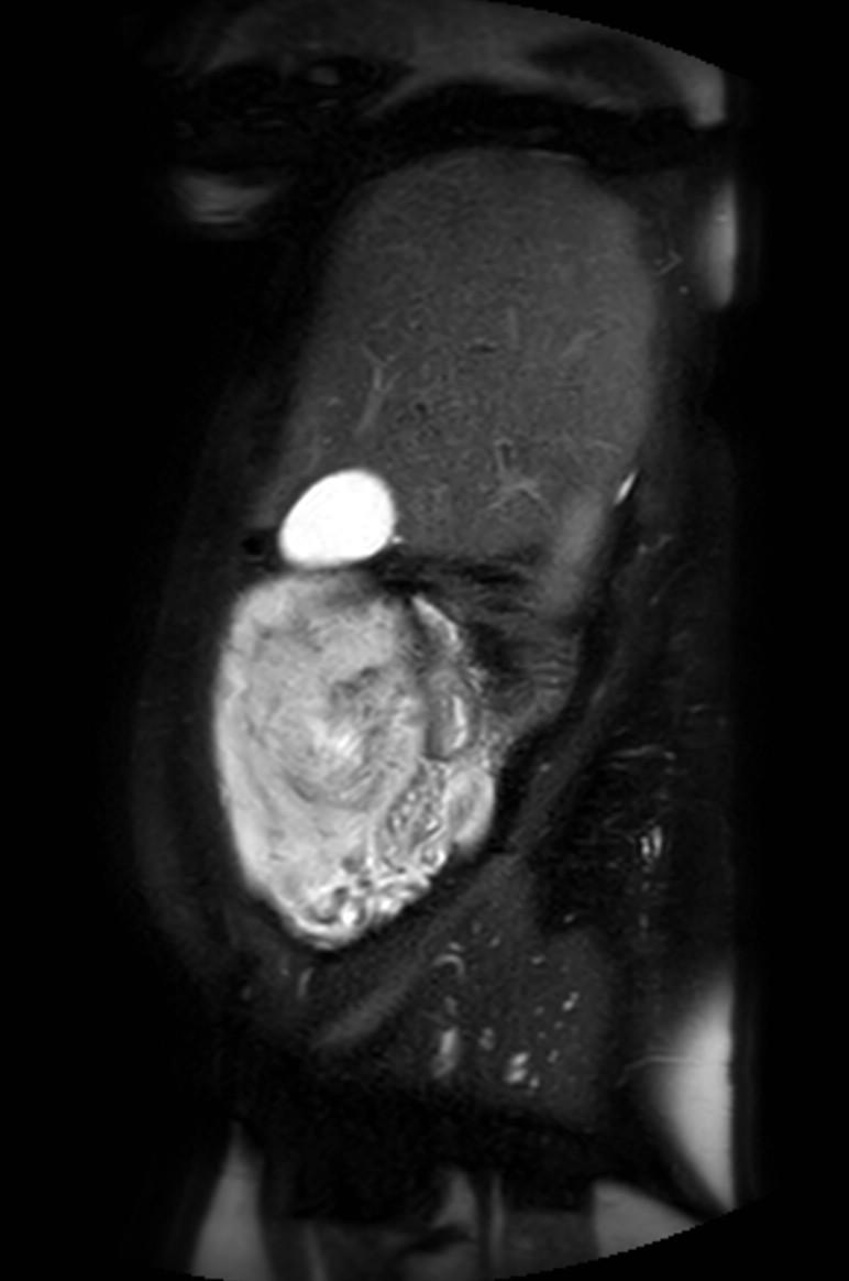 Appendicitis in gravida (MRI) (Radiopaedia 89433-106395 Sagittal T2 SPAIR 51).jpg