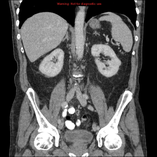 File:Appendicitis mass in inguinal hernia (Radiopaedia 26858-27029 B 43).jpg