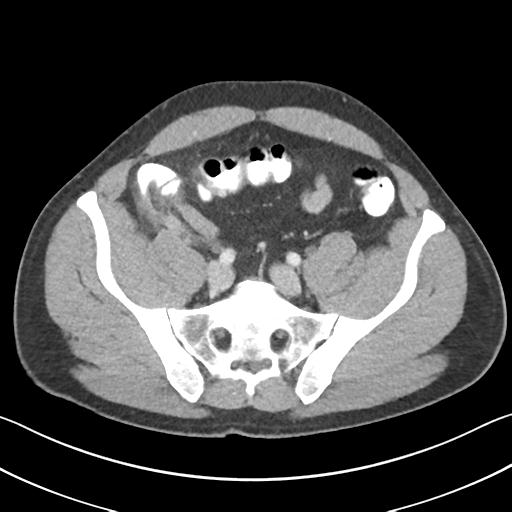 Appendicitis with cecal bar sign (Radiopaedia 31878-32830 B 60).jpg