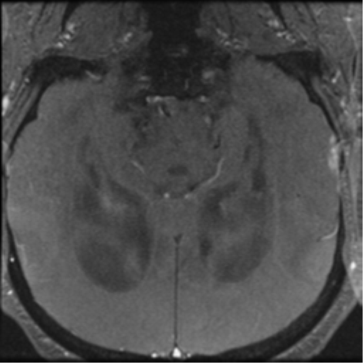 Aqueduct stenosis with corpus callosum hypoattenuation post shunting (Radiopaedia 37212-38969 Axial CSF Flow 54).png