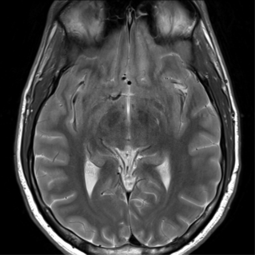 File:Arachnoid cyst - cerebellopontine angle (Radiopaedia 59689-67083 Axial T2 24).png