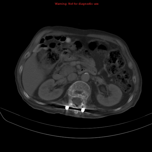 File:Arachnoiditis ossificans (Radiopaedia 51394-57136 Axial bone window 12).jpg