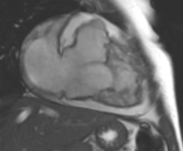 Arrhythmogenic right ventricular cardiomyopathy (Radiopaedia 69431-79307 2ch cine 51).jpg