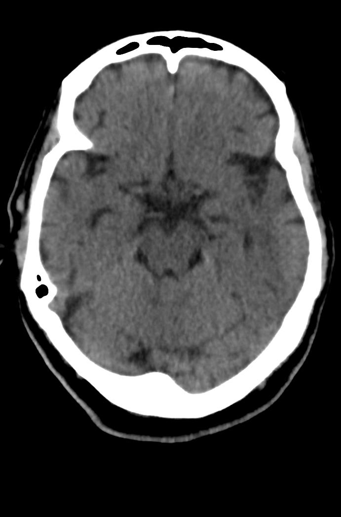 Artery of Percheron infarction (Radiopaedia 80613-94202 Axial non-contrast 74).jpg