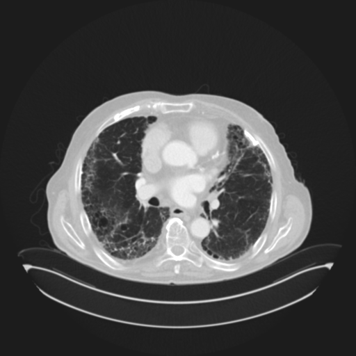 Asbestosis (Radiopaedia 56192-62864 Coronal lung window 1).png