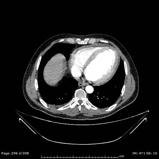 File:Ascending aortic aneurysm (Radiopaedia 50086-55404 A 76).jpg
