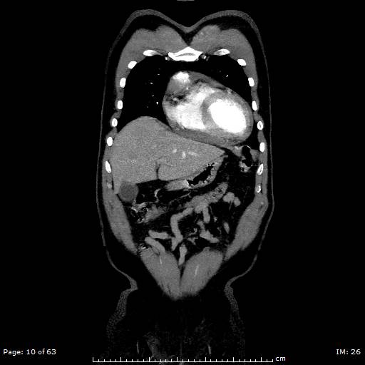 Ascending aortic aneurysm (Radiopaedia 50086-55404 B 10).jpg