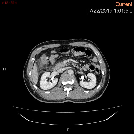 File:Ascending colonic diverticulum mimicking acute appendicitis (Radiopaedia 69943-80198 A 59).jpg