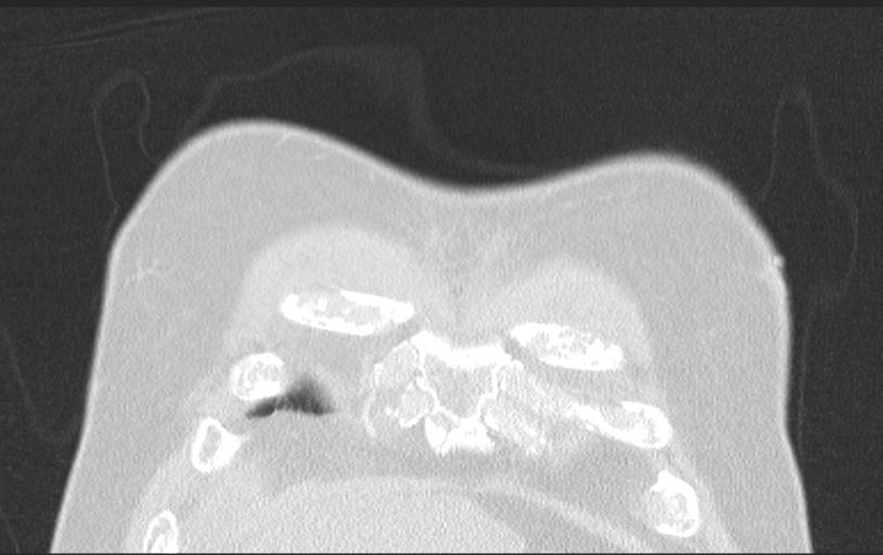 Aspirated tooth (Radiopaedia 28584-28844 Axial lung window 23).jpg