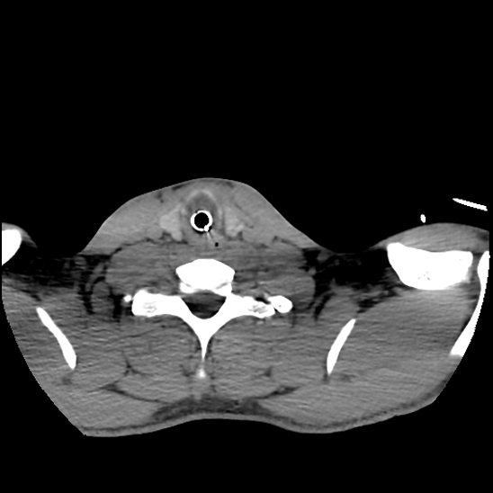 File:Atlanto-occipital dissociation (Traynelis type 1), C2 teardrop fracture, C6-7 facet joint dislocation (Radiopaedia 87655-104061 Axial non-contrast 73).jpg