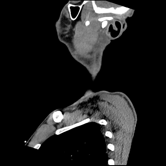 Atlanto-occipital dissociation (Traynelis type 1), C2 teardrop fracture, C6-7 facet joint dislocation (Radiopaedia 87655-104061 D 13).jpg