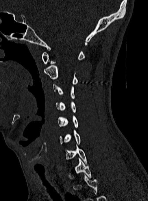 Atlantoaxial subluxation (Radiopaedia 44681-48450 Sagittal bone window 38).jpg